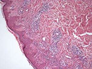 perivascular lymphocytic infiltrate