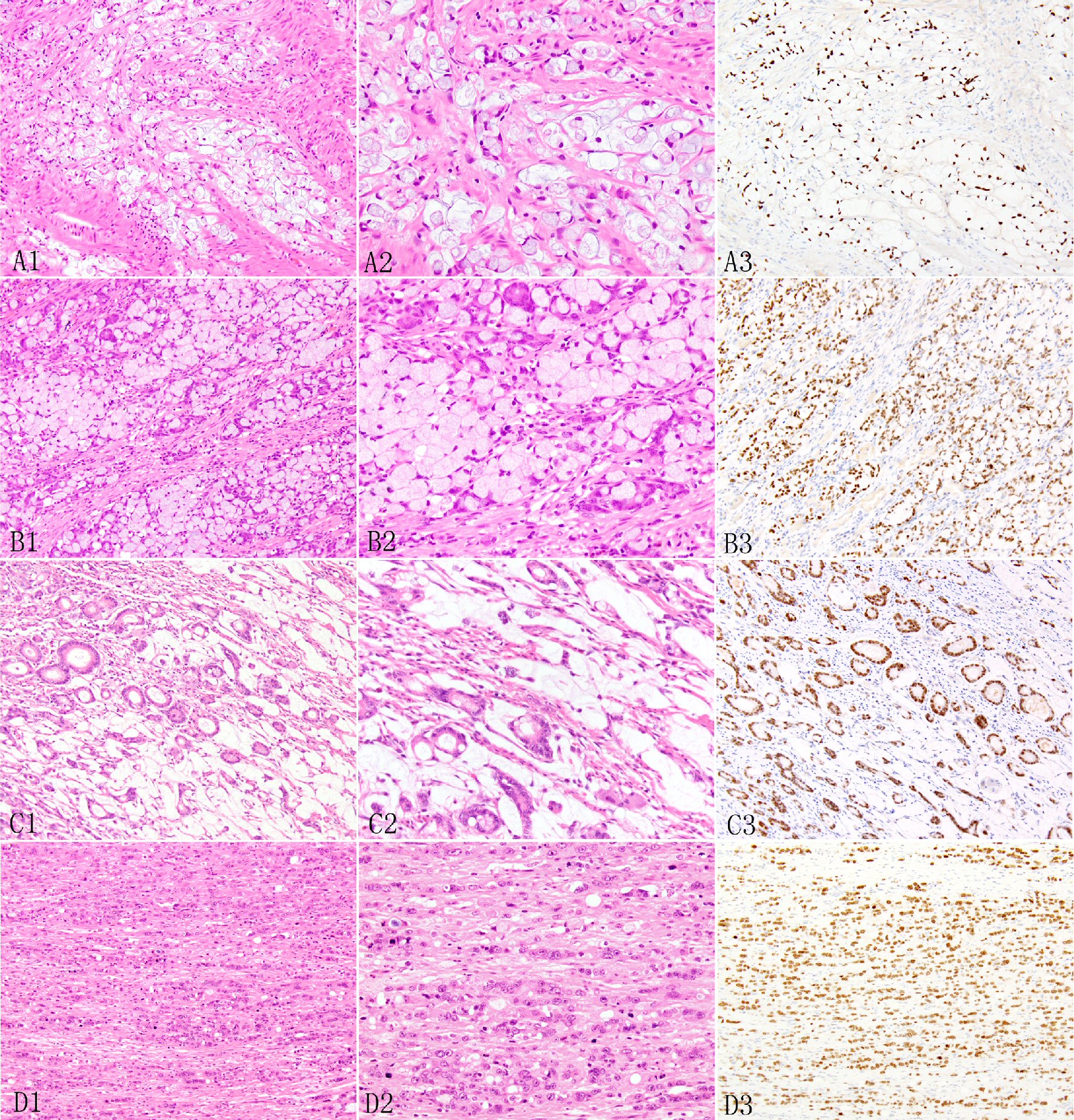 Frontiers | Comparative analysis of tumor biology and prognosis in mucinous  and signet-ring cell colon cancers versus classical adenocarcinoma