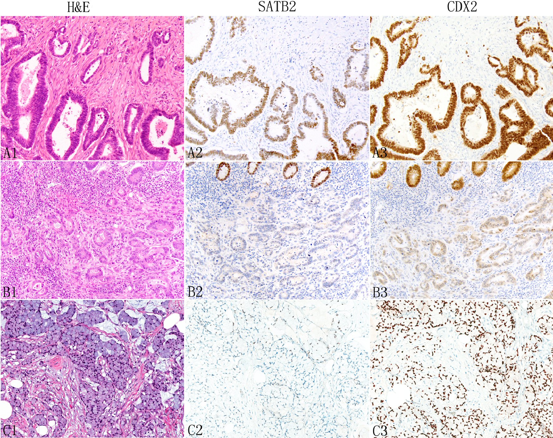 Pathology Outlines - Goblet cell adenocarcinoma