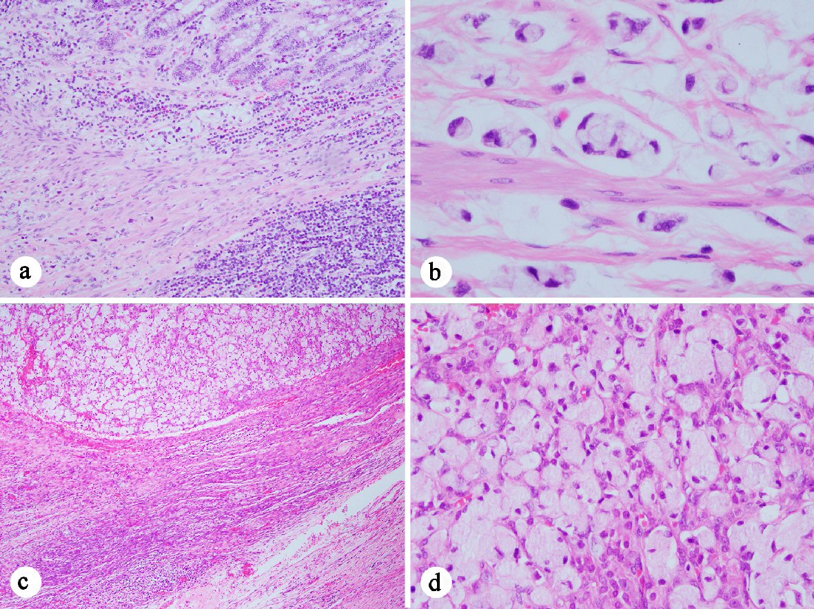 File:Signet ring cell carcinoma of the urinary bladder - alt -- intermed  mag.jpg - Wikimedia Commons