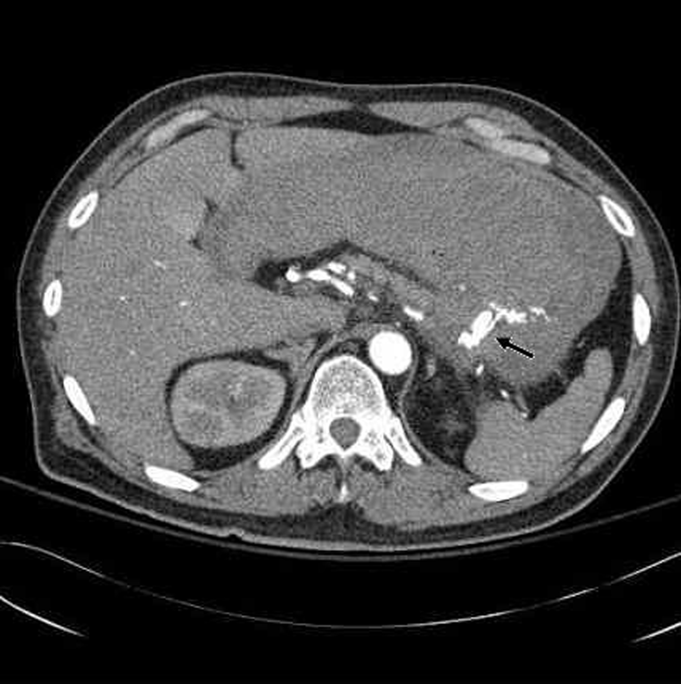 Penetration of Gastric Ulcer into the Splenic Artery: A Rare ...